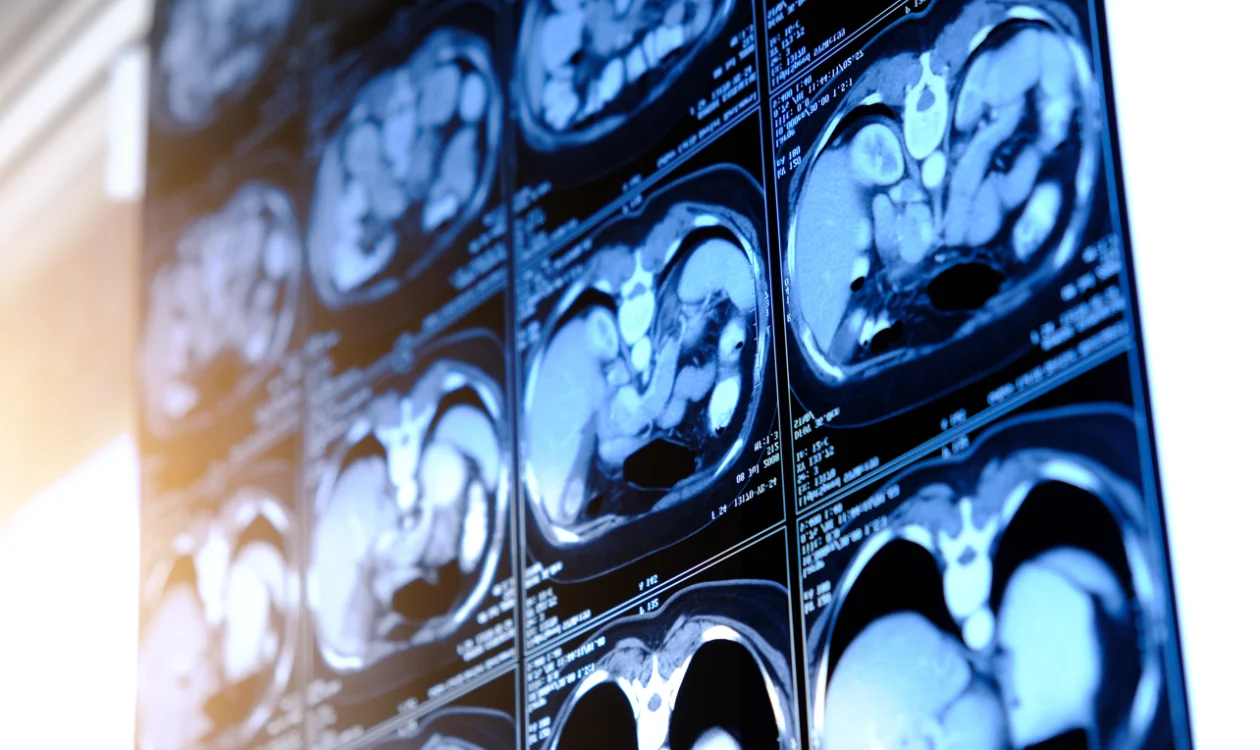 Screen of kidney scans