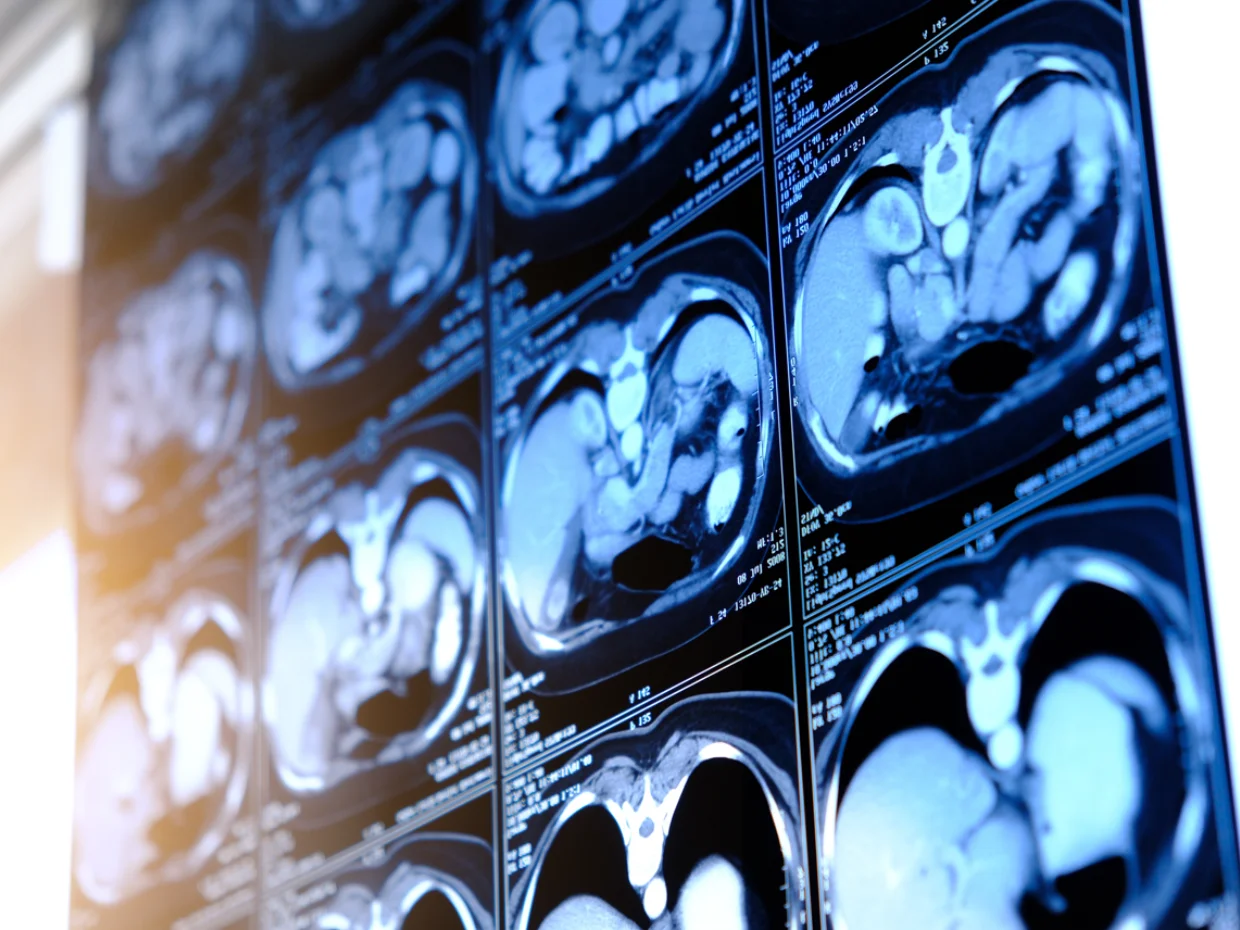 Screen of kidney scans