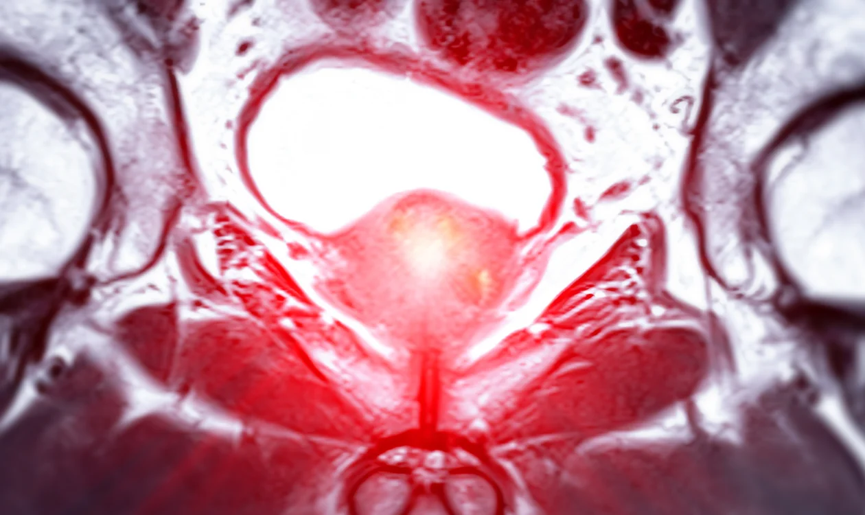 MRI image of the prostate gland