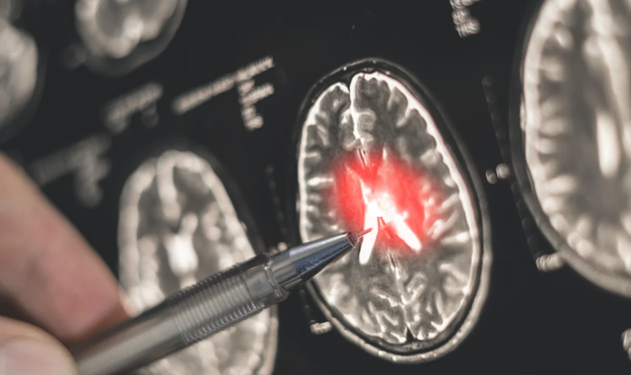 Brain scan showing a tumour