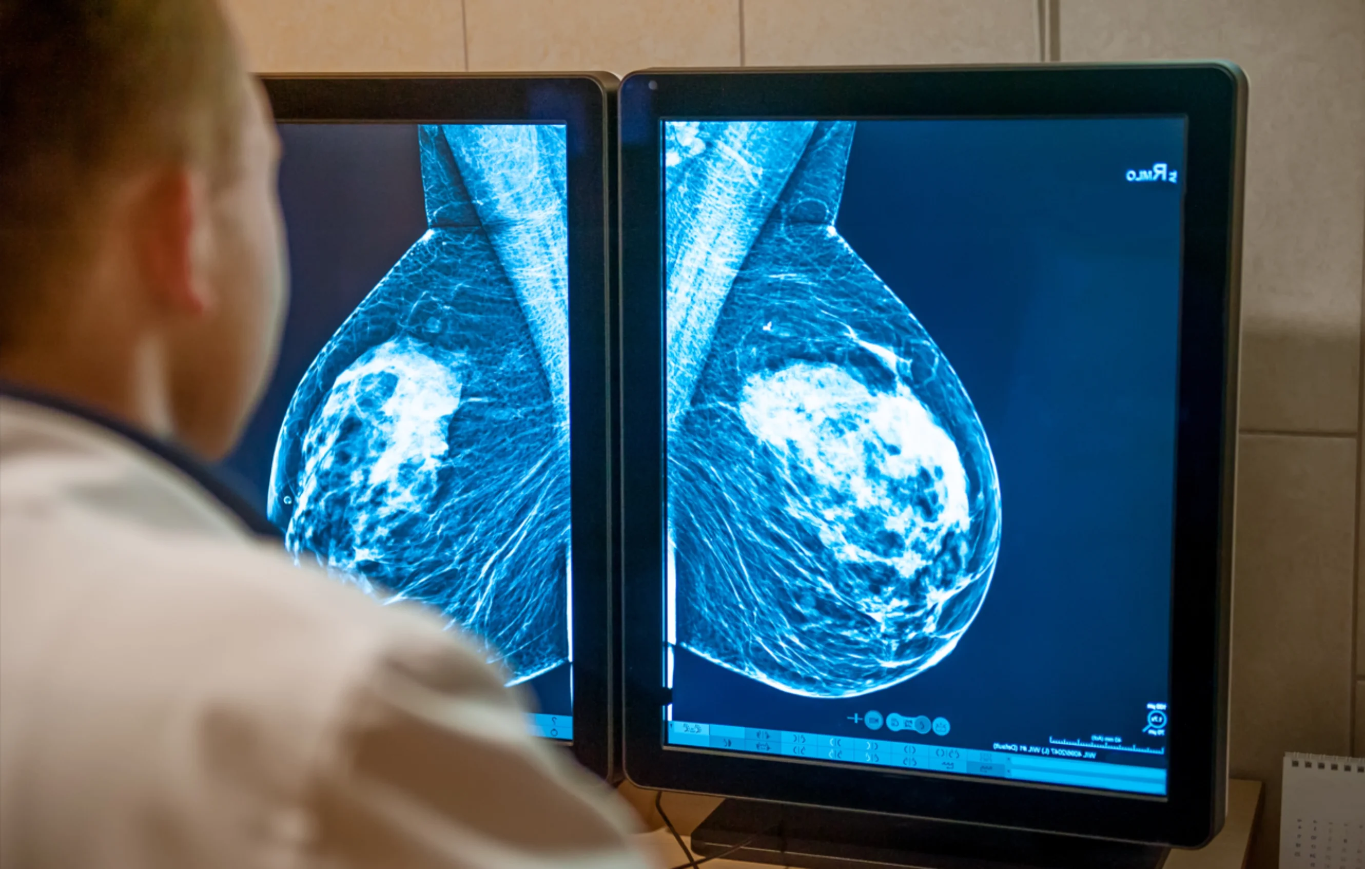 Breast cancer scan