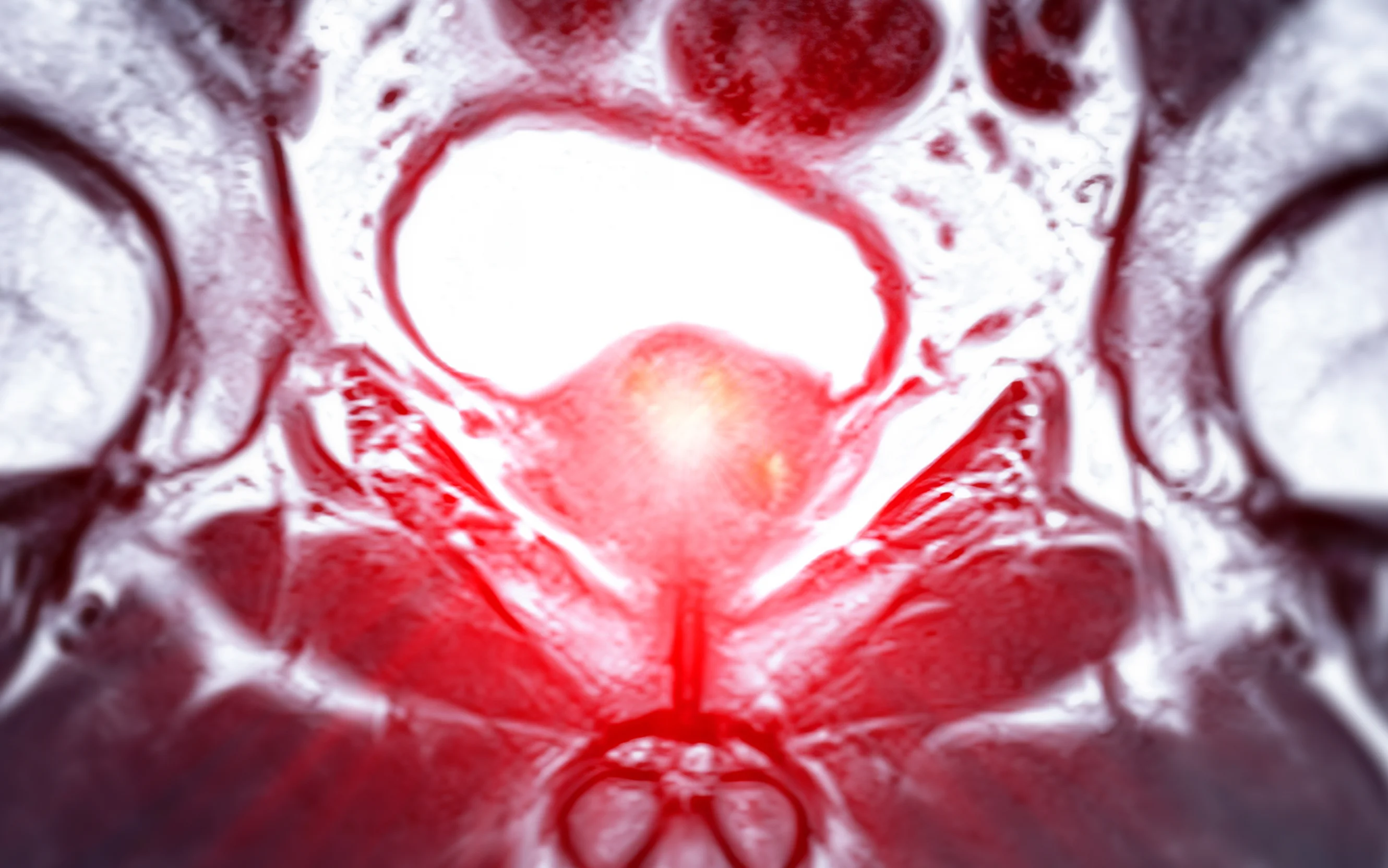 MRI image of the prostate gland