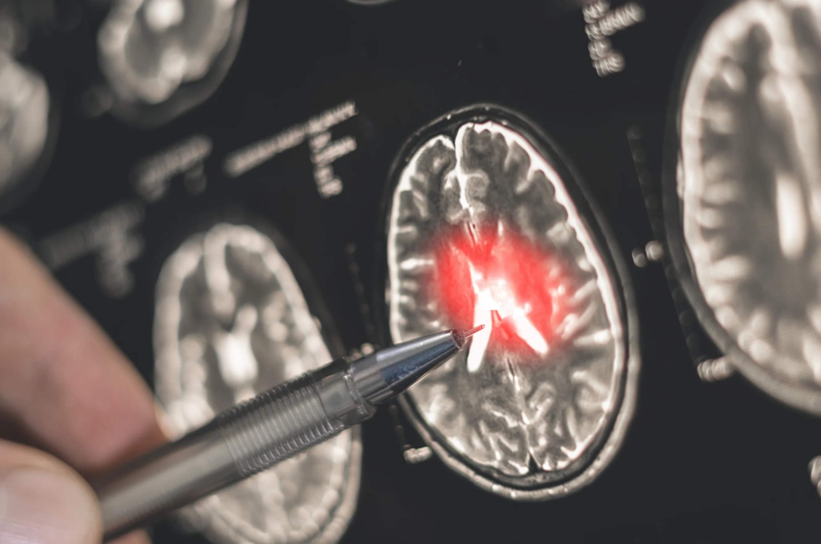 Brain scan showing a tumour