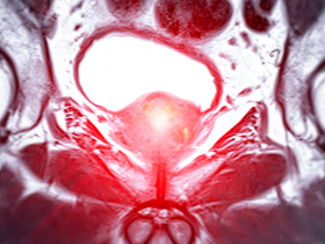 MRI image of the prostate gland