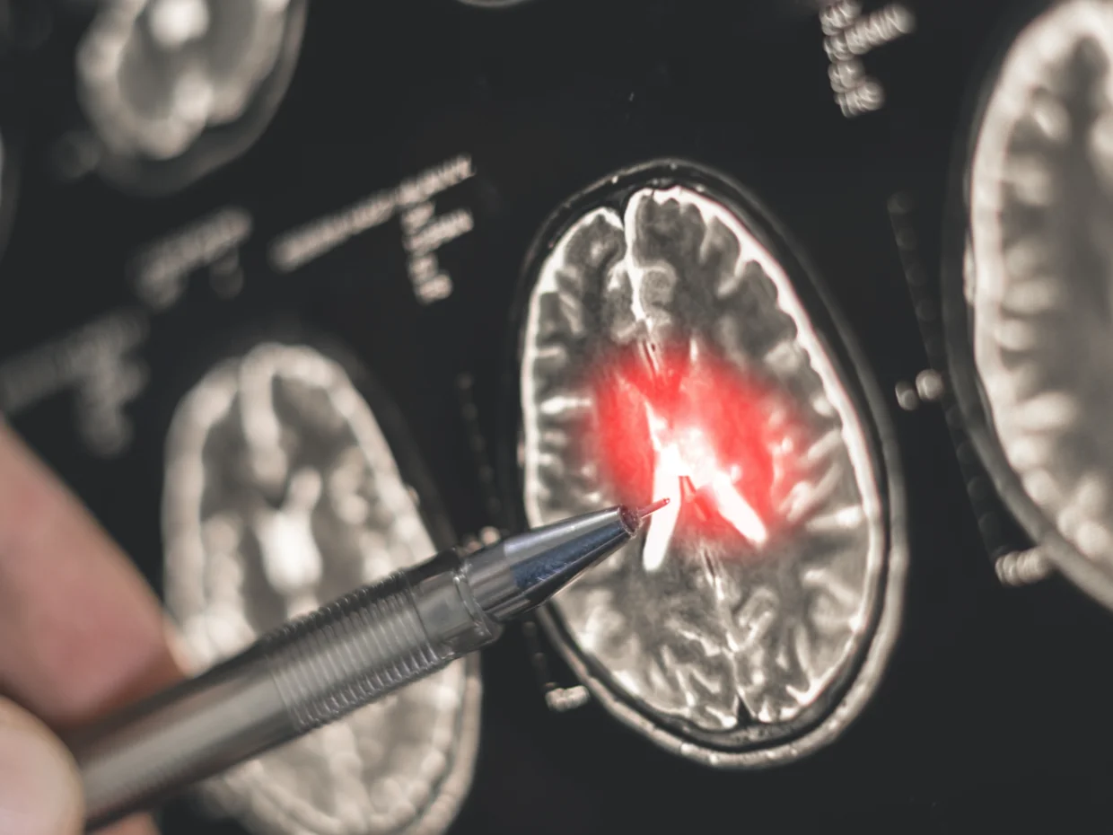 Brain scan showing a tumour